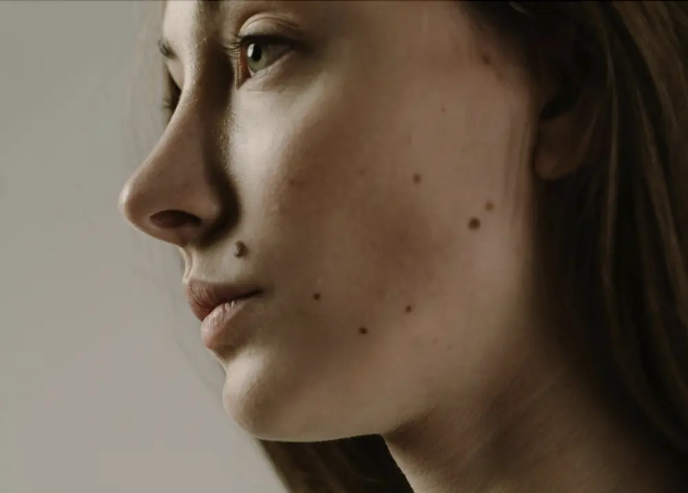 Close-up of benign moles on a person's face.