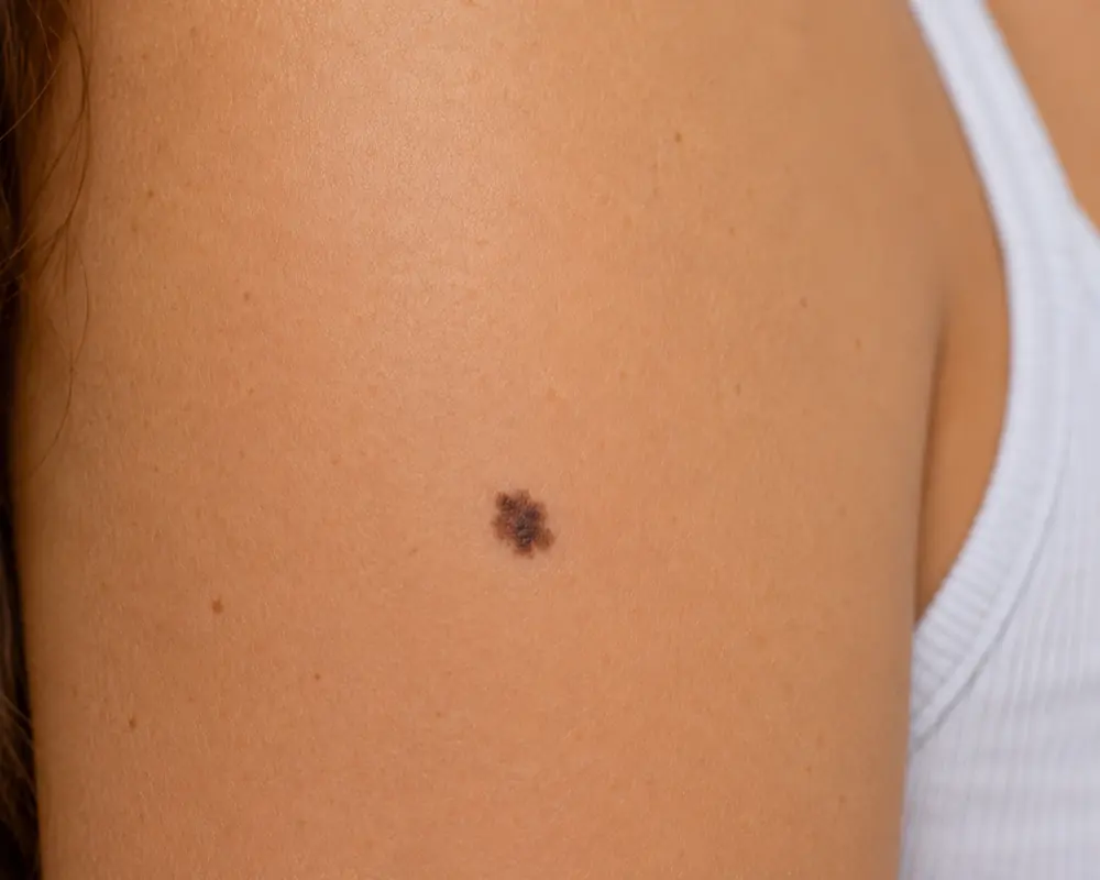 A melanoma skin lesion showing irregular borders and colour.