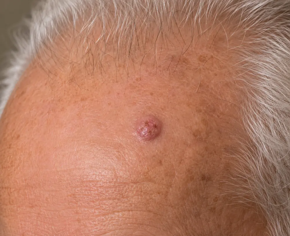 A squamous cell carcinoma lesion on sun-exposed skin.